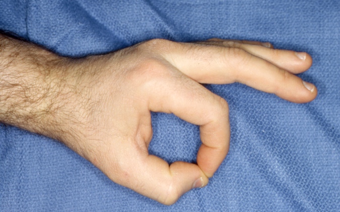 Normal froment's sign ("O" sign). The thumb MP joint is not hyper-extended. the thumb IP joint is only moderately flexed, and the long finger is not supporting the index finger.