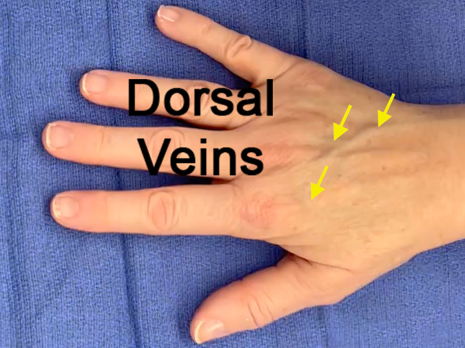 The dorsal veins are visible on the dorsum of the hand (see arrows).