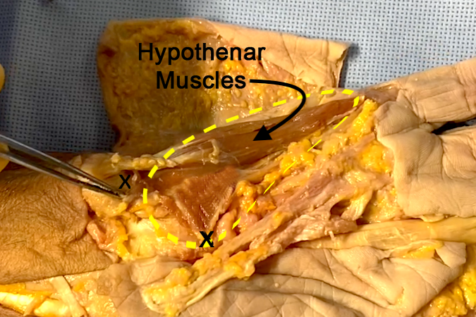 Hypothenar muscles (yellow ellipse) with "X's" marking the pisiform and hook of hamate origins. 