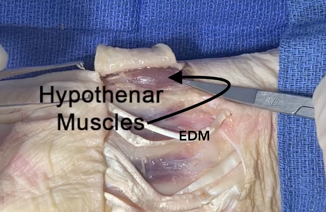 Hypothenar muscles including the abductor digiti minimi as viewed from the dorsal ulnar part of section 9.