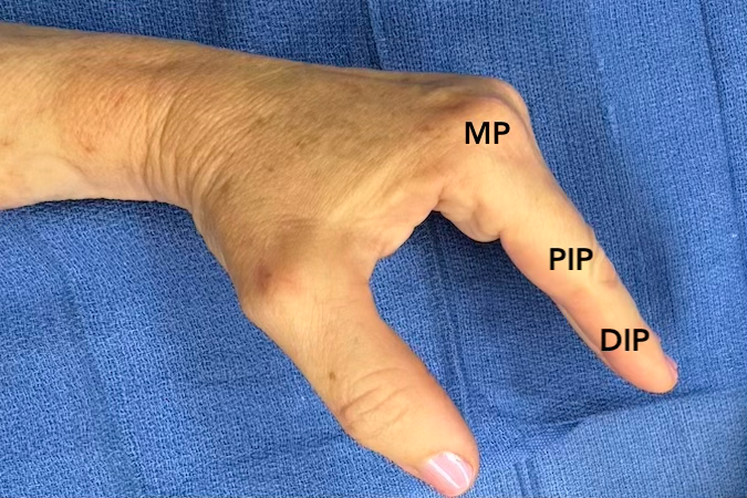 The interossei contribute to the intrinsic plus position by flexing the MP joints and extending the PIP and DIP joints.