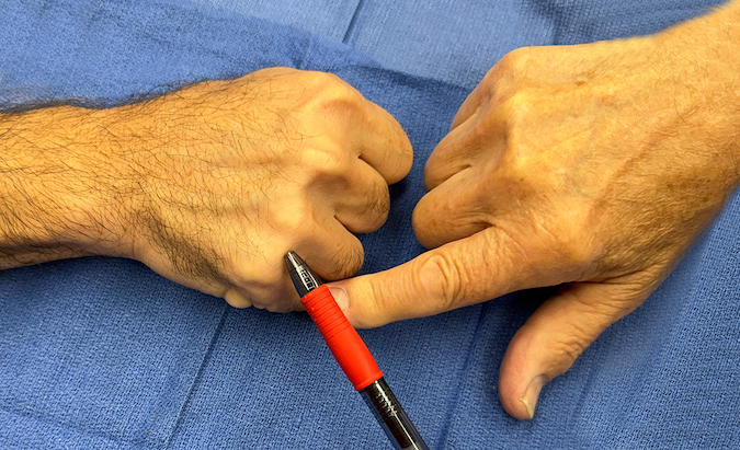 The junctura tendinum move distally as the patient makes a fist. In this position the junctura can be seen as a visible palpable fascial ridge between the metacarpal heads.  See the 4-5 junctura at the tip of the pen.