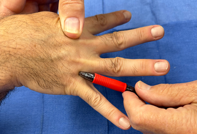 With extension the junctura move proximally and are more difficult to see and palpate. Note the 4-5 junctura and the tip of the pen.