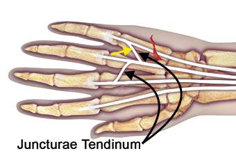 A laceration of the EDM can be masked on  active range of motion testing by an intact juncturae tendon (yellow arrow).