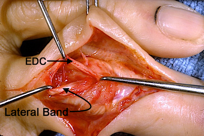Surgical image showing the EDC and the lateral band