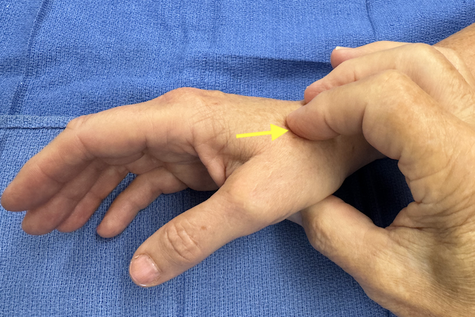 Palpating the deep branch of the radial artery in the base of the dorsal first web (arrow).