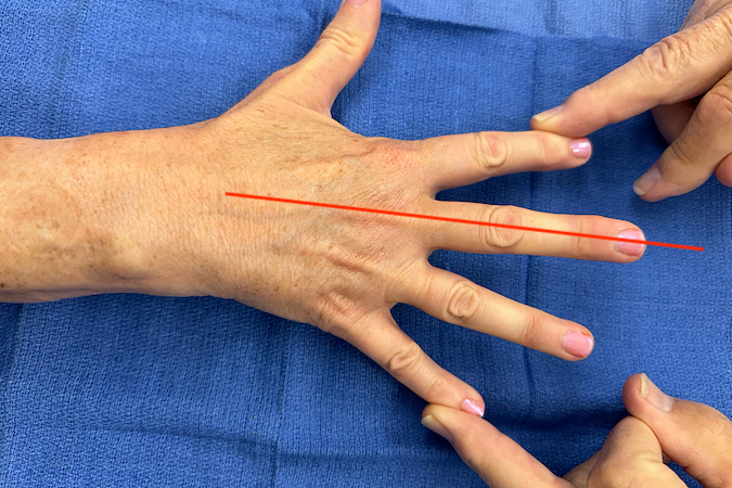 Fingers abducting away from the central long finger ray (red line) against resistance during muscle testing of the dorsal interosseous muscles.
