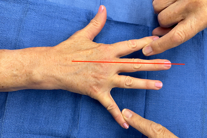 Fingers adducting towards the central long finger ray (red line) against resistance during muscle testing of the palmar interosseous muscles.