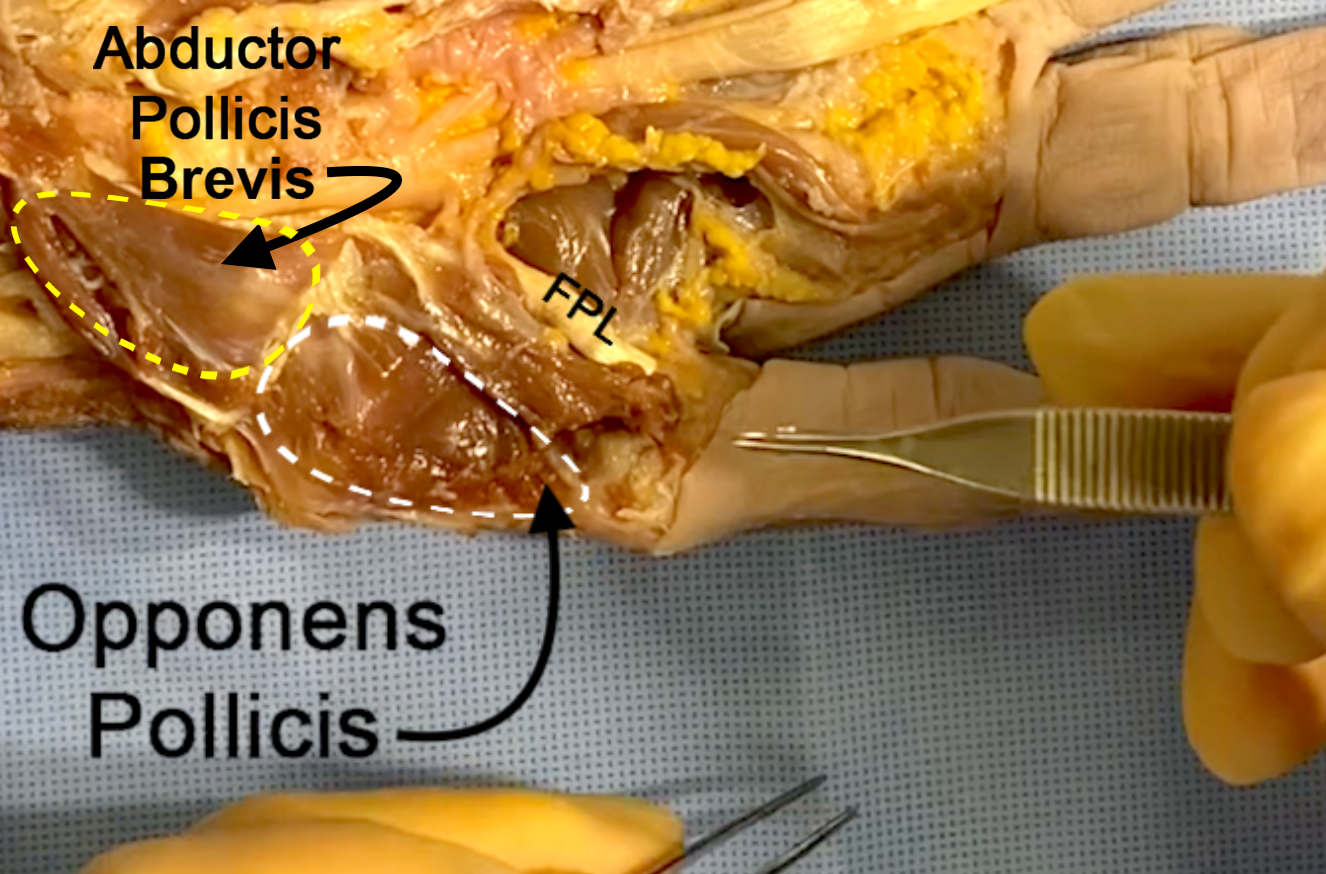 Opponens pollicis (OP) with abductor pollicis brevis folded proximally. Note relationship of FPL to thenar muscles.