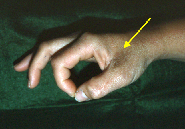 Positive Froment's sign.  Note the atrophy of the first dorsal interosseous (arrow).