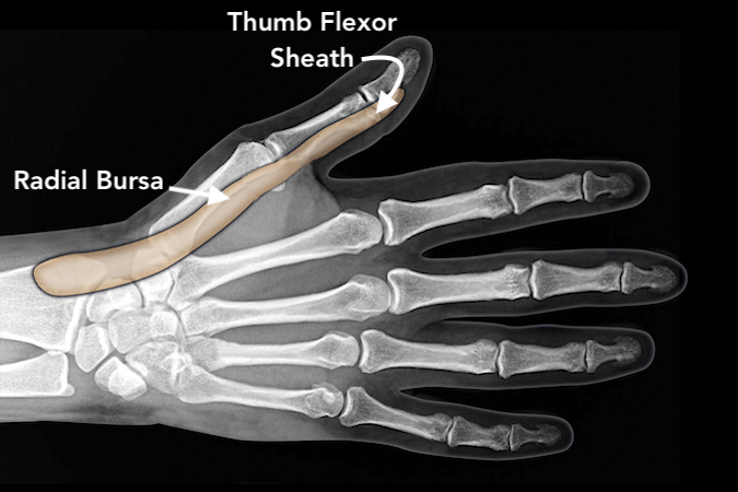 The thumb flexor sheath connects to the radial bursa.