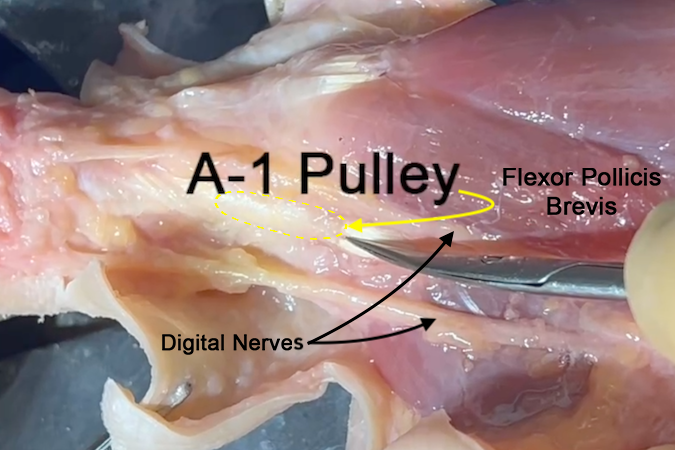 A-1 pulley of the thumb flexor sheath (yellow ellipse). Also note the FPL under the pulley and tip of the scissors. Digital nerves and flexor pollicis brevis are also labeled.