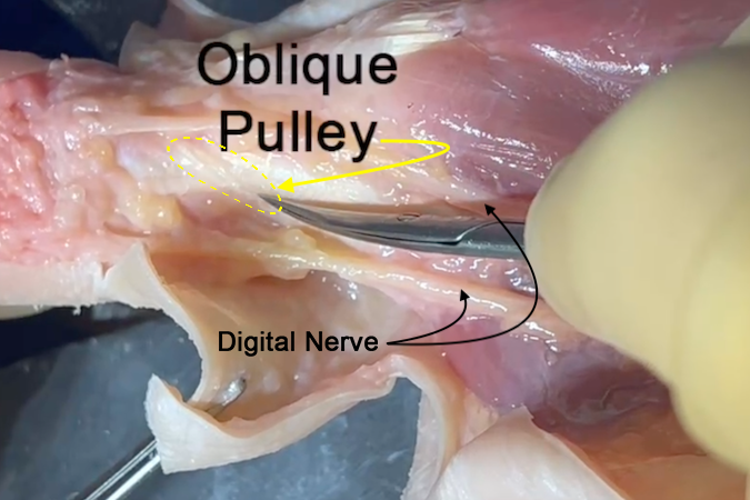 Oblique pulley of the thumb flexor sheath (yellow ellipse). 