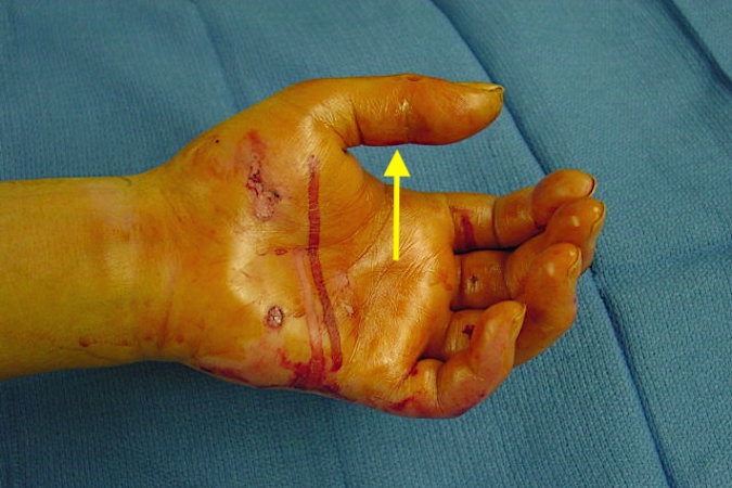 Infected swollen thumb flexor tendon sheath (arrow).
