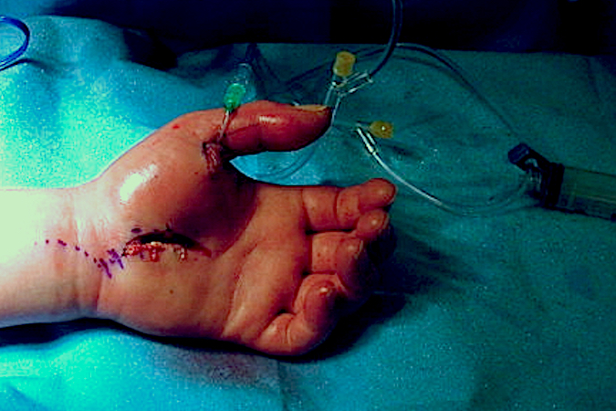 Surgical debridement and irrigation of thumb flexor sheath infection.