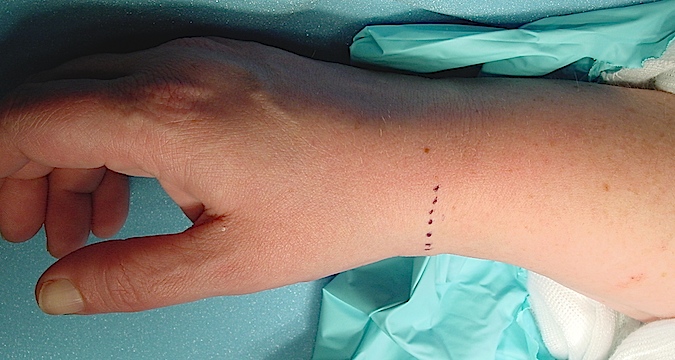 Incision for the release of the first dorsal extensor compartment to treat DeQuervain's tendonitis.