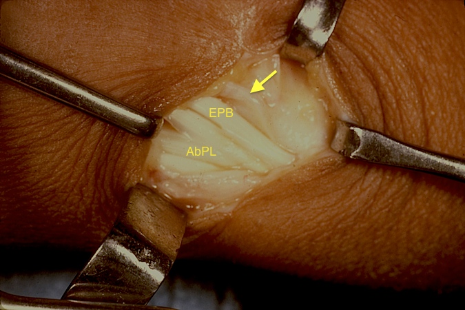 Open incision for DeQuervain's release. Note the AbPL, the EPB, and the cut dorsal edge of the extensor compartment (arrow).
