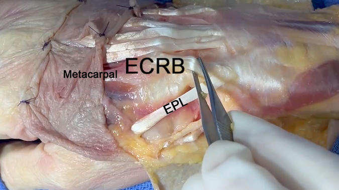 ECRB is seen inserting into the base of the second metacarpal after crossing under the EPL.