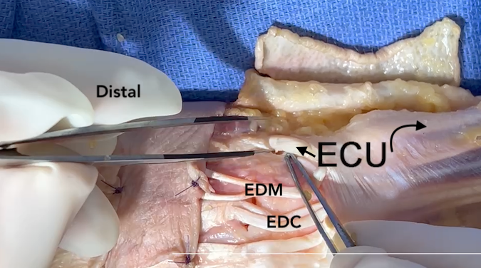 The extensor carpi ulnaris muscle and tendon (ECU).