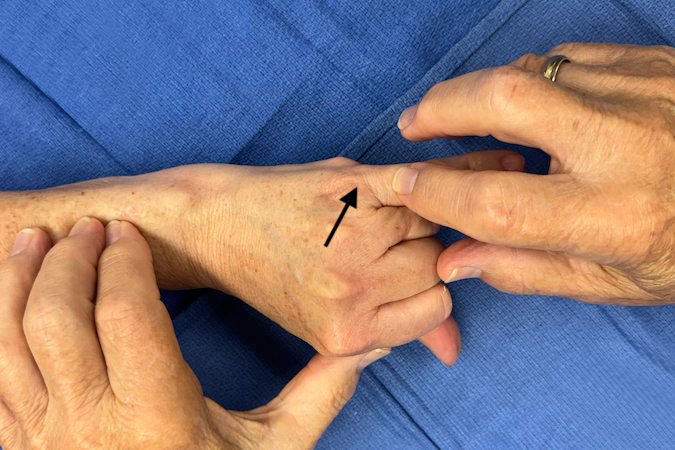 	EDM (arrow) Muscle Testing. Note the index, long, and ring are held in flexion and muscle belly being palpated.