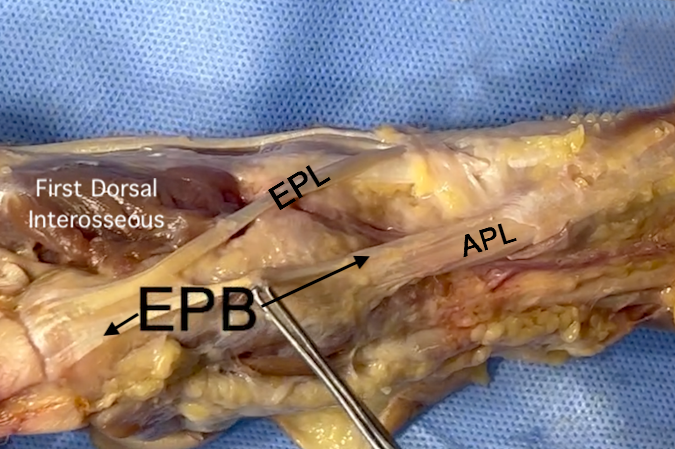 Note the EPB tendon.