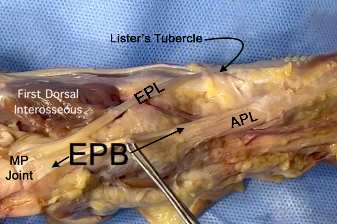Note EPL, EPB, AbPL, and Lister's tubercle.