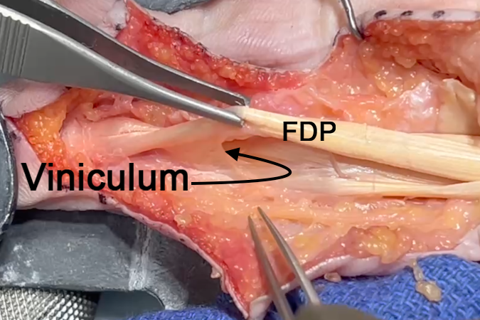 Note the vinculum brevis attaching to the dorsal distal FDP.