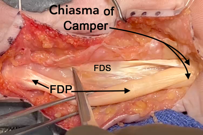 Palmar dissection at PIP joint level with flexion sheath removed.  Note FDP and FDS tendons  and the Chiasma of Camper.