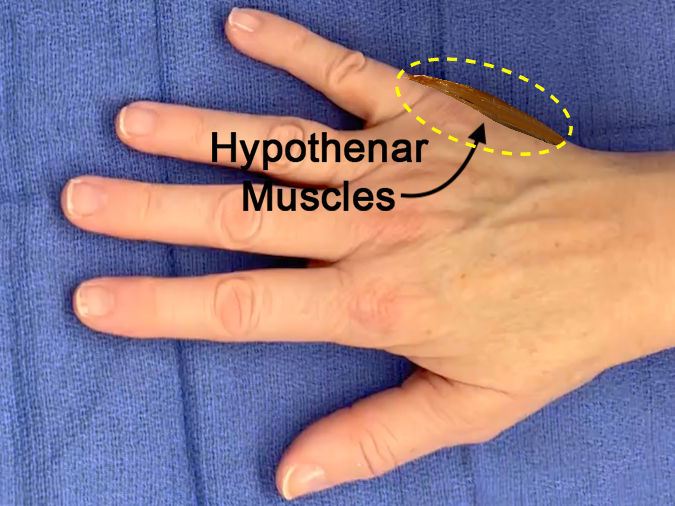 Location of the hypothenar muscles from a dorsal view.