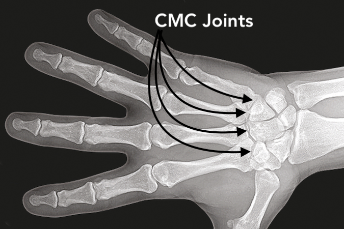 The 2nd through 5th CMC joints. The 2nd through 5th CMC joints.