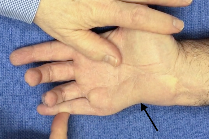 Note hypothenar atrophy (arrow) and weak abduction of the little finger.