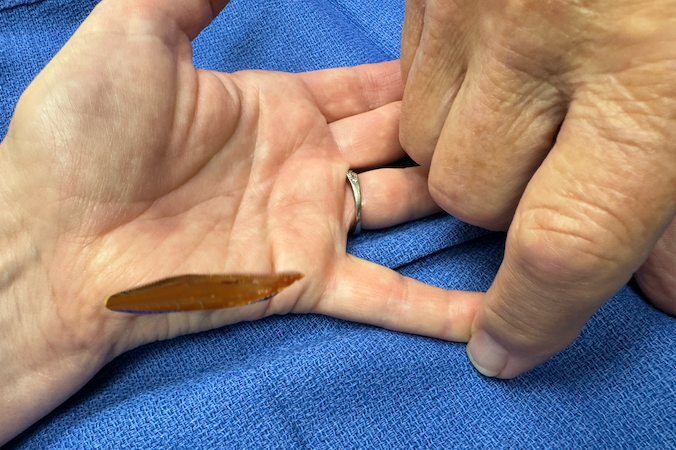 Location of the hypothenar muscles from a palmar view.