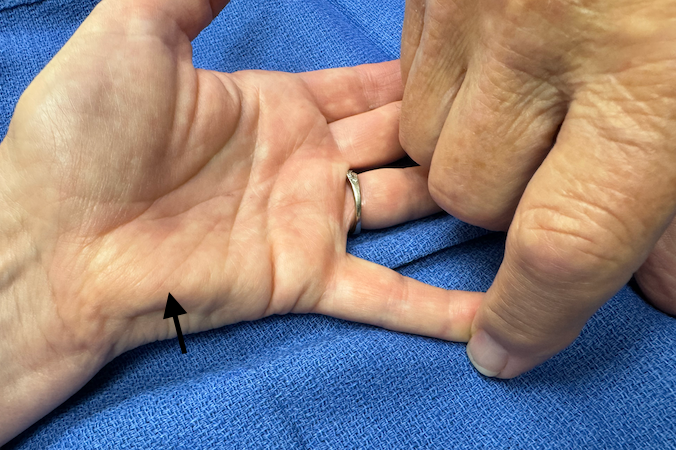 Testing hypothenar muscles (arrow) by resisting little finger abduction.