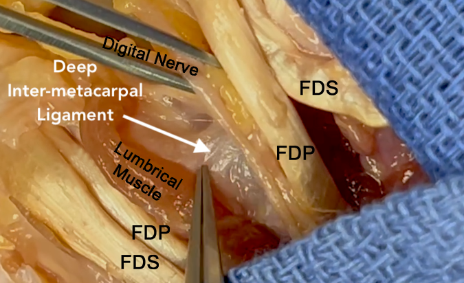 The deep inter-metacarpal ligament is the dorsal wall (roof) of the lumbrical canal. Note the FPD, FDS, and digital nerve.