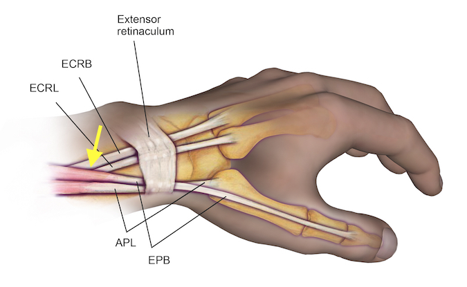 Intersection Syndrome is caused by inflammation in the area (arrow) between the radial wrist extensors (ECRB&ECRL) and the thumb abductor and extensor (APL & EPB).
