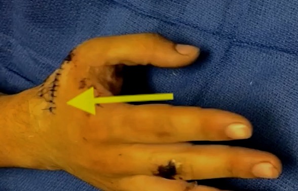 Lacerations(arrow)of the EPL, EPB, and the APL. Note the position of the thumb.