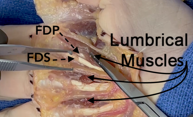 Lumbricals are shown on the radial side of the flexors (FDP & FDS) of the index, long, and ring flexor sheaths.
