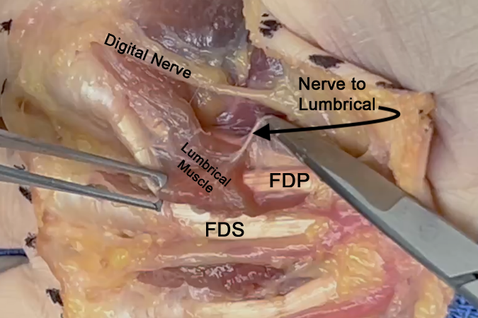 Nerve to the lumbrical muscle.