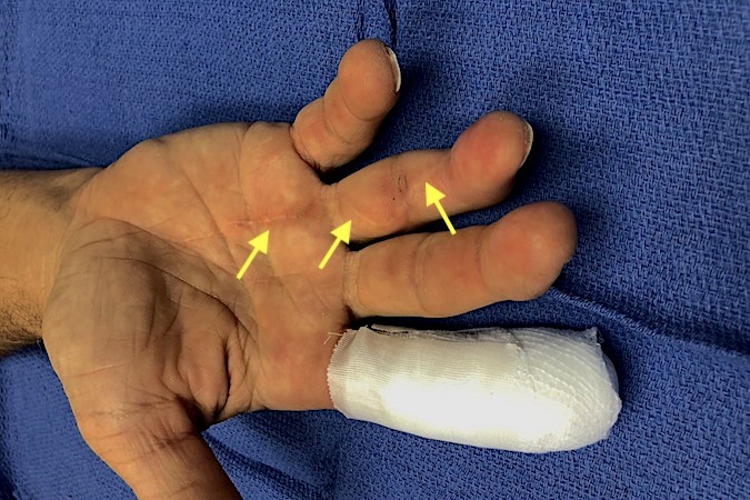Note scar (yellow arrows) from previous tendon grafting.