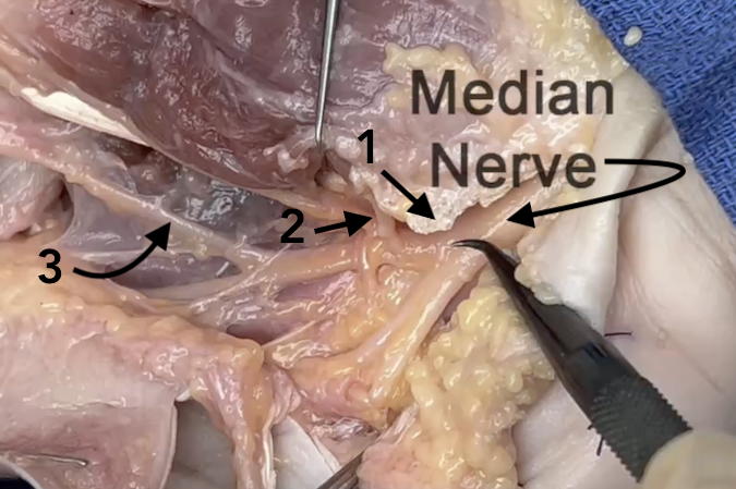 Median nerve in the carpal tunnel. Note cut edge of carpal ligament (1), median nerve motor branch (2), and ulnar digital nerve of the thumb.