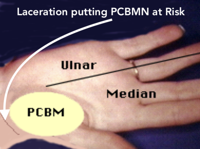 Laceration marked by line causing painful paresthesias and sensory loss in the area of the palmar cutaneous branch of the median nerve (yellow ellipse).