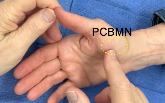 Testing sensation in area of the palmar cutaneous branch of the median nerve.