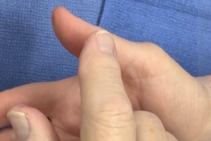 Testing sensation (light touch) on the radial aspect of the palmar thumb.