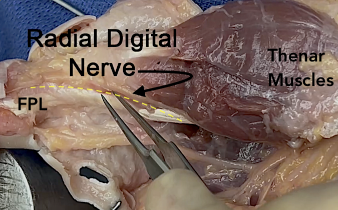 Radial digital nerve of the thumb.  Note FPL and thenar muscles.