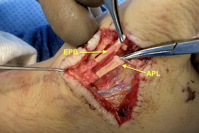 Note EPB and AbPL tendon lacerations in section 10.