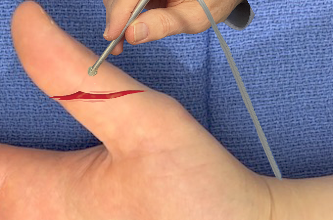 Doppler assessment of the thumb radial digital artery distal to a palmar thumb laceration.