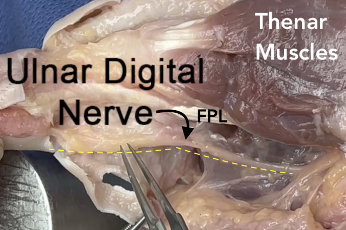 Anatomy of the ulnar digital nerve of the thumb.