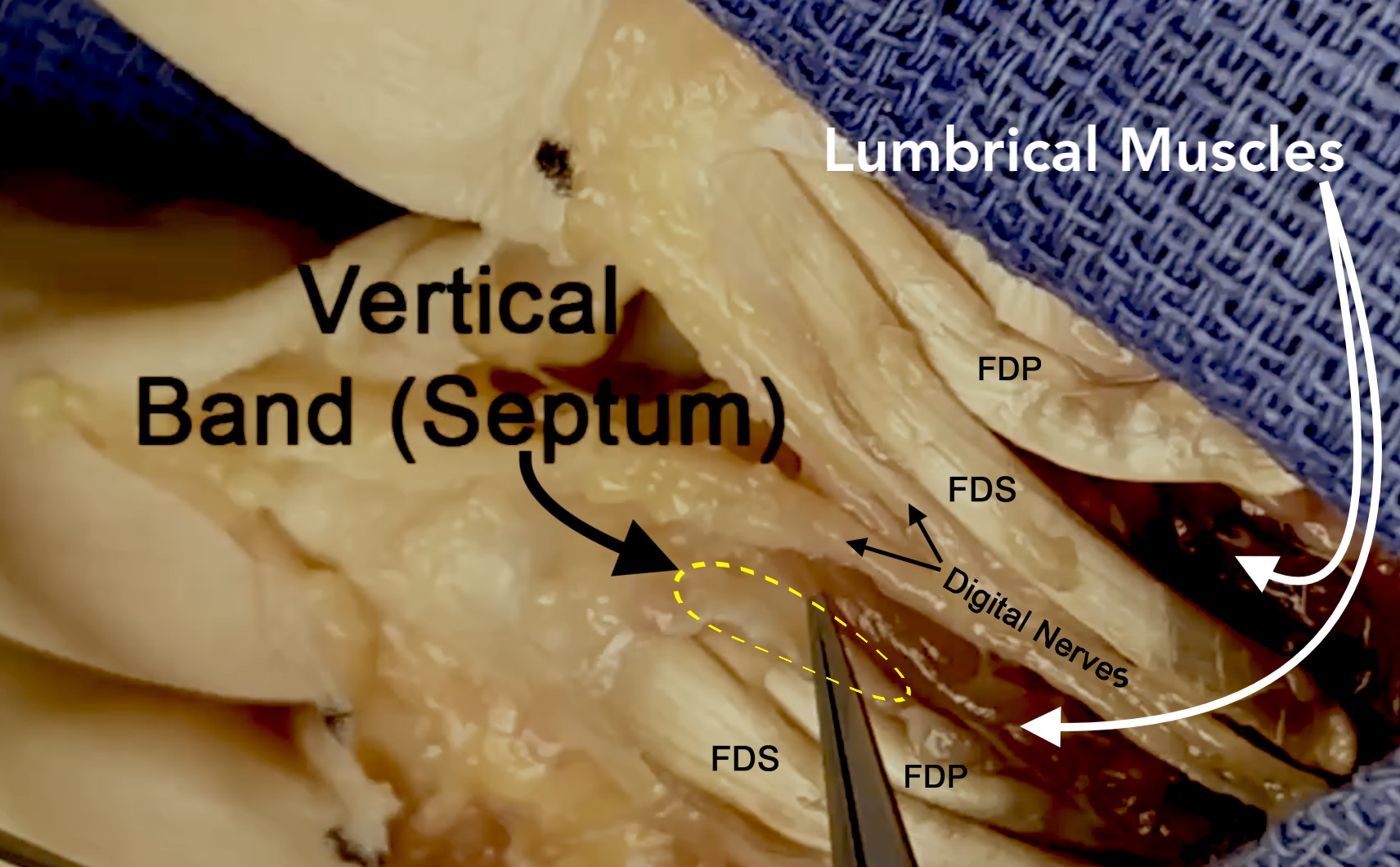 Vertical septum (yellow ellipse) forms ulnar wall of lumbrical canal. Note lumbrical muscles, FDP, FDS, and Digital nerves.
