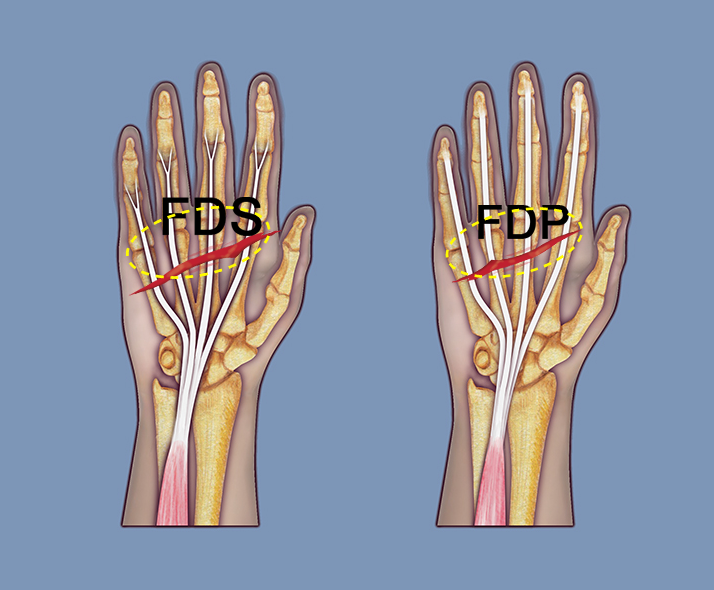 Lacerations in section 7 potentially can transect 4 FDP tendons and 4 FDS tendons.