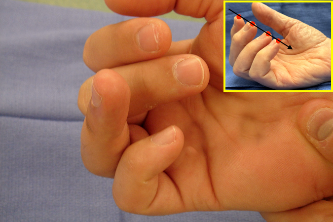 2.	Note the disruption of the finger flexion cascade withe a laceration of the ring FDP tendon and absence ring finger DIP joint flexion.  Insert shows normal finger flexion cascade.